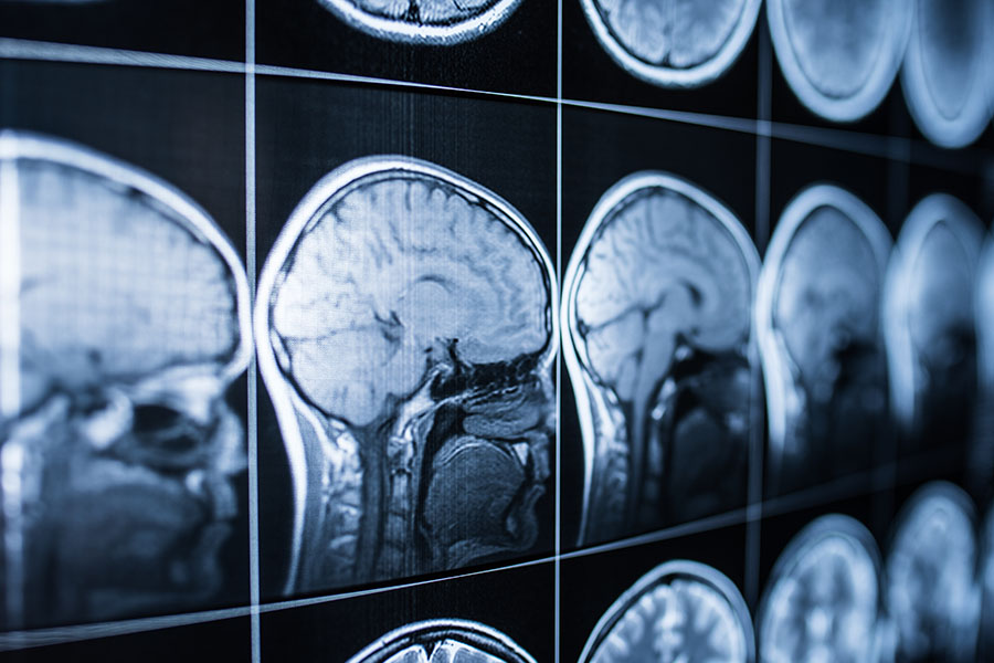 Easing the Financial Burden of Brain Injuries Through Legal Representation - Featured Image