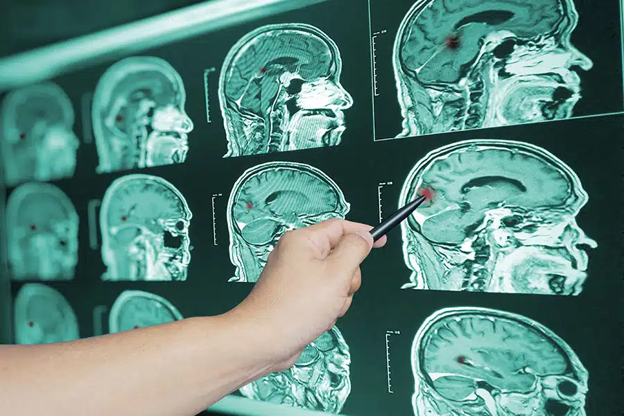 A hand uses a pen to point at a highlighted area on a brain MRI scan displayed on a screen.